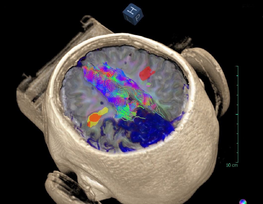 diffusion-sensor-imaging-what-is-it-exactly