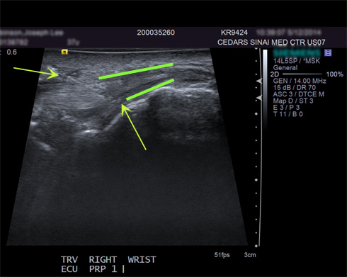 PRP Wrist (Extensor carpi ulnaris - ECU tear) | Cedars-Sinai